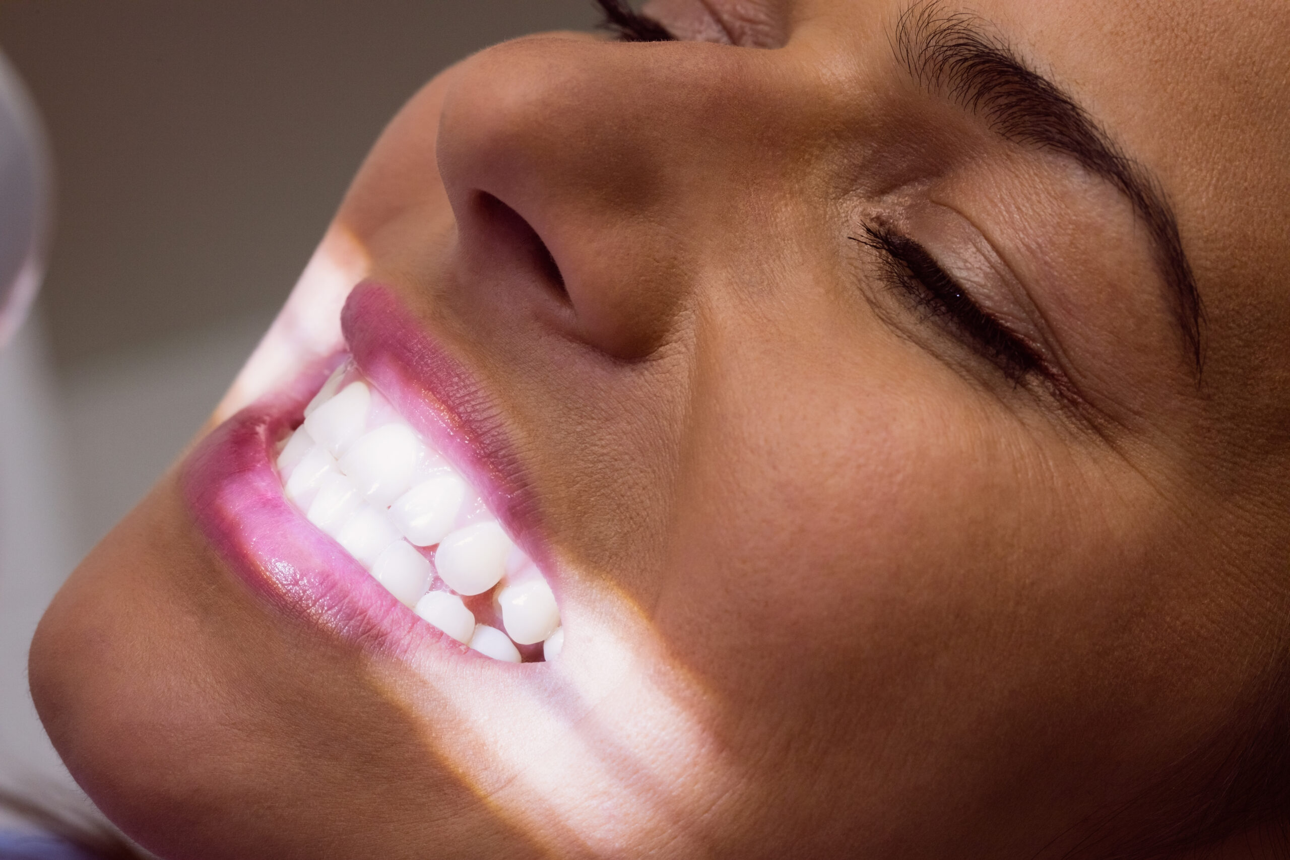 clareamento dental